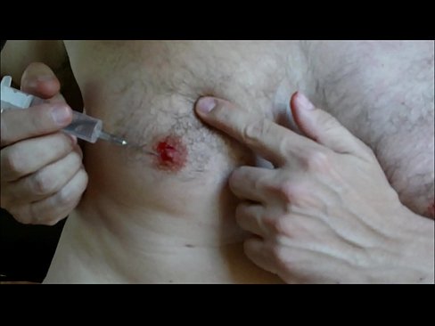 Taz reccomend nipple injection