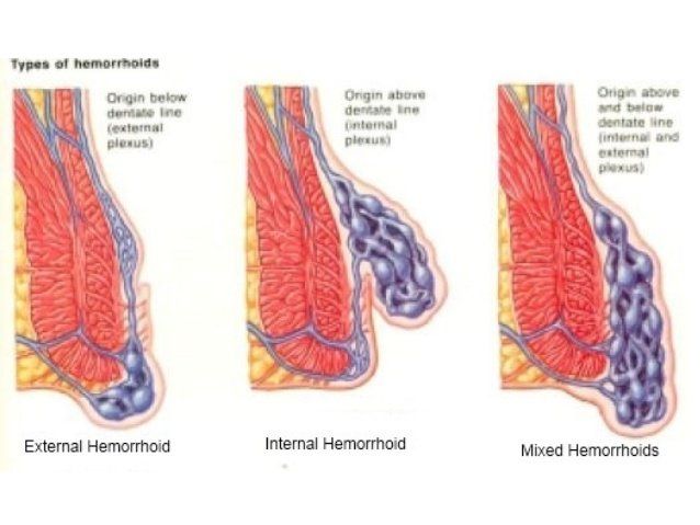 Diesel reccomend white shltting farting hemorrhoids